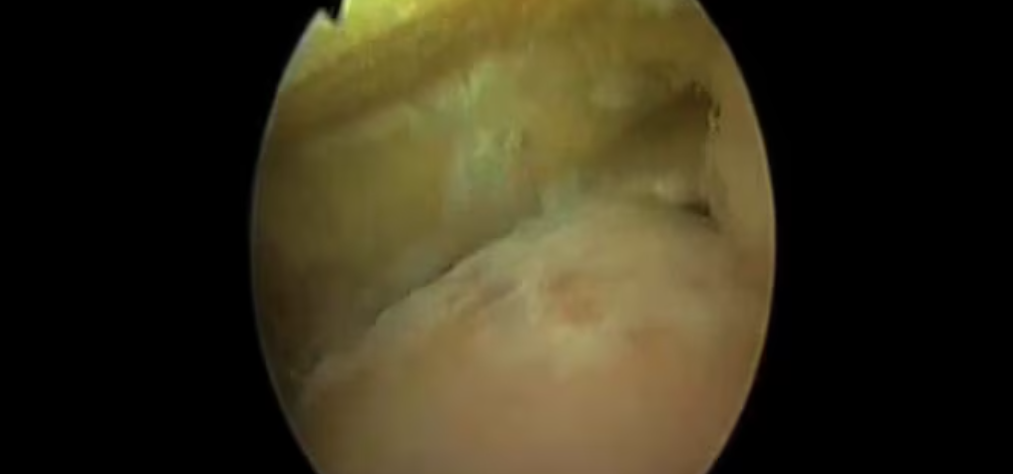 Arthroscopic Ankle Arthrodesis