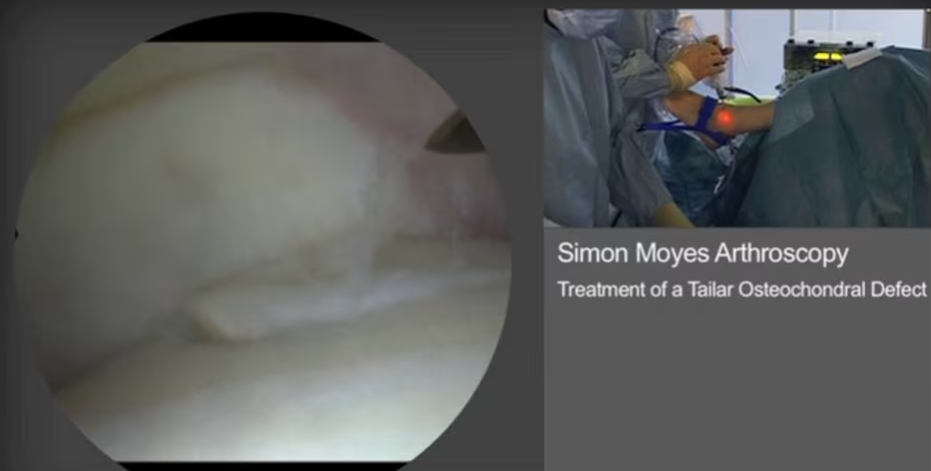 Ankle Arthroscopy: Arthroscopic Treatment of a Talar Osteochondral Defect