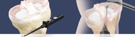 Cartilage tears behind the kneecap can be treated more effectively using new technology like the Arthrex meniscal repair system