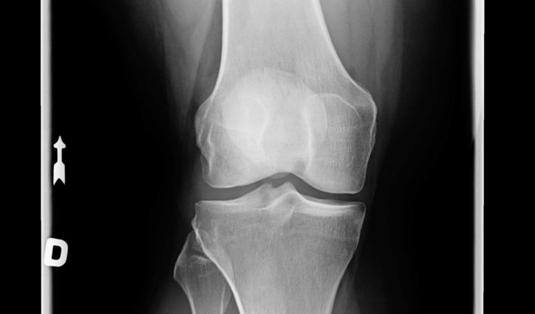 What to Expect During Knee Cartilage Surgery