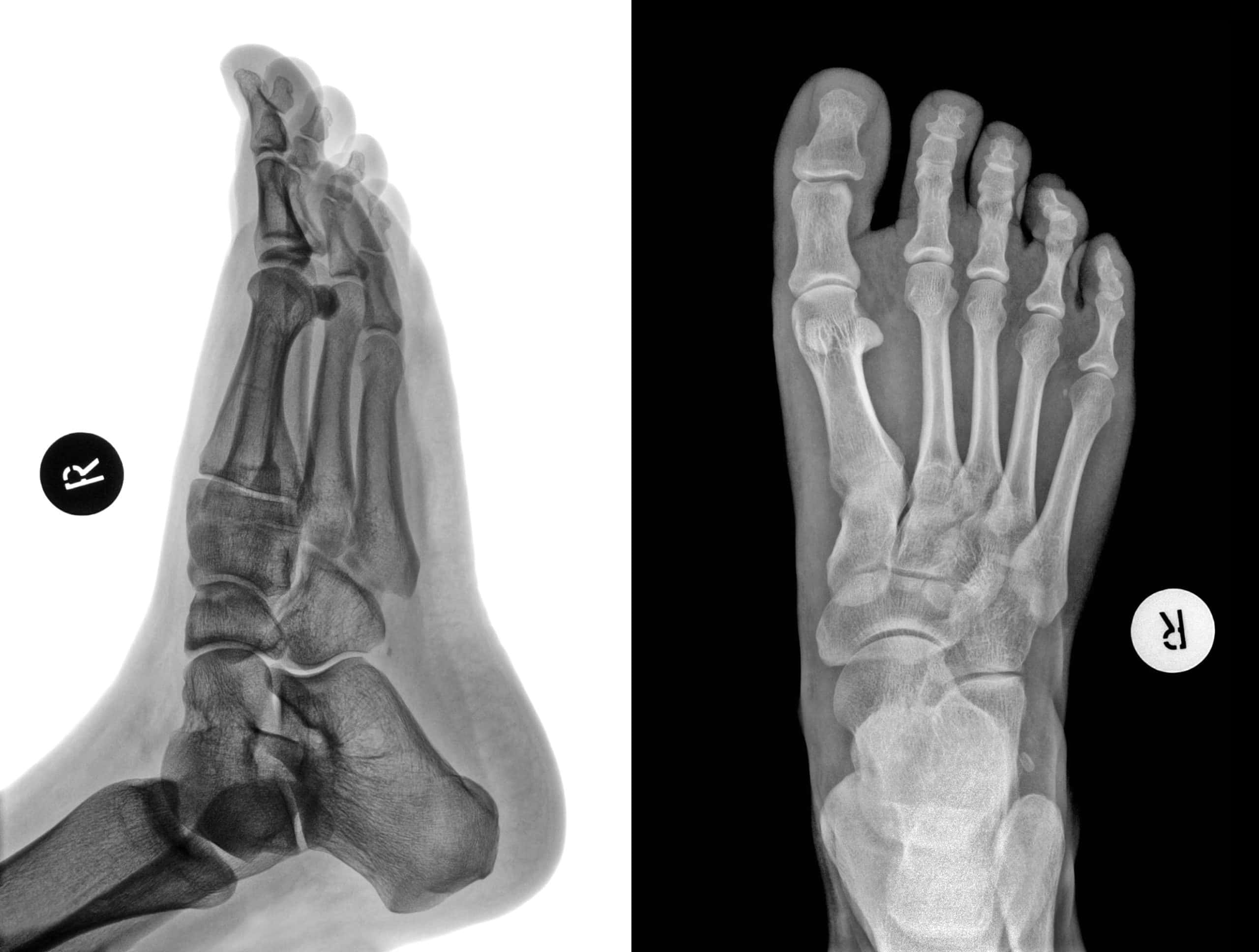 ankle bones x ray